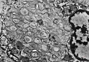 M,6m. | myelinoid inclusions in cerebral neuron - Nieman-Pick disease M,6m. | myelinoid inclusions in cerebral neuron - Nieman-Pick disease